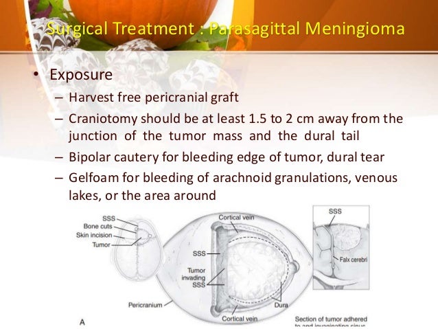 meningioma headaches meningioma brain tumor frontal lobe